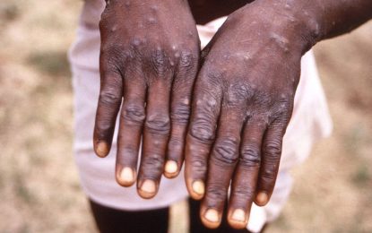 Health Ministry issues guidelines to deal with Monkeypox