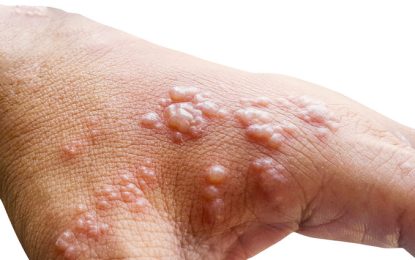 Caribbean monitoring spread of Monkey-pox