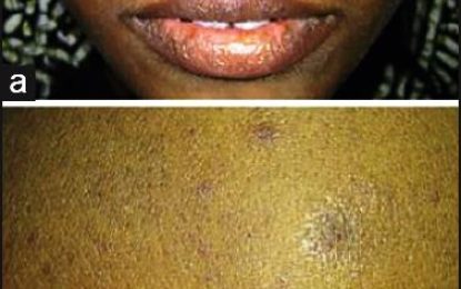 Lupus: An autoimmune disease