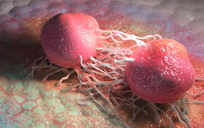 Four in ten cancer cases could be prevented globally – WHO