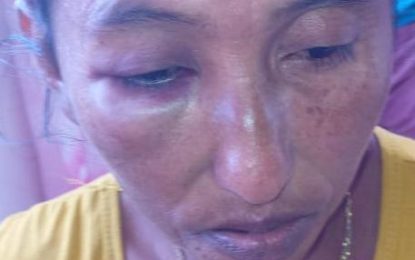 Woman who was savagely beaten by toshao’s daughter seeks justice