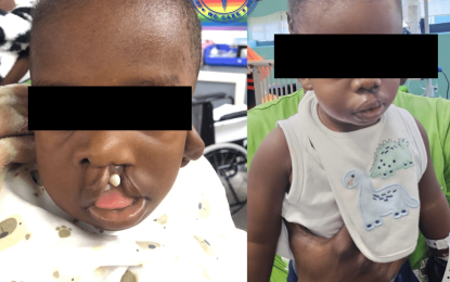 Nine successful cleft surgeries done independently at GPHC