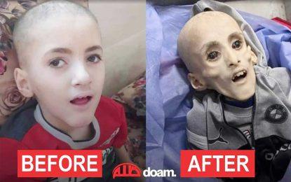 One of many Palestinian children dies from starvation in Gaza