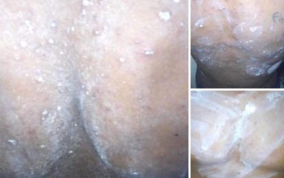 Chicken-pox outbreak under control – Guyana Prison Service