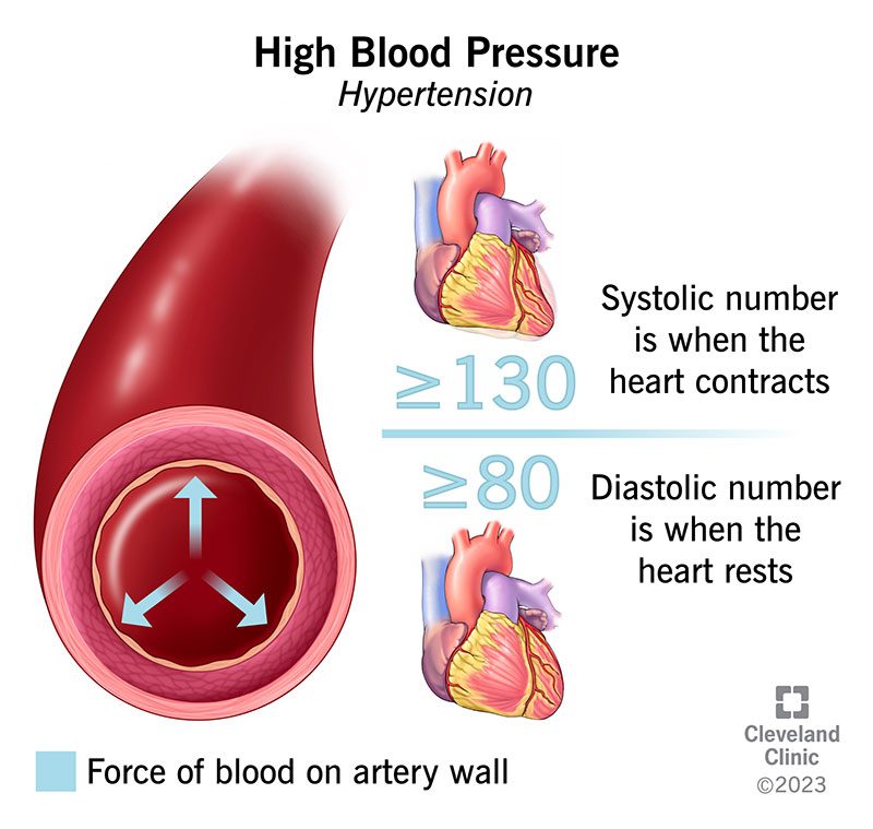 Uncontrolled high blood pressure puts over a billion people at risk