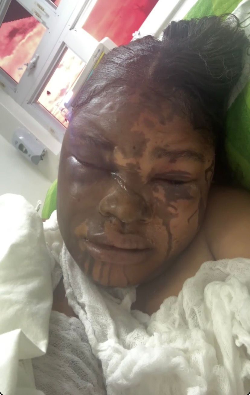 Two women doused with acid, hospitalized