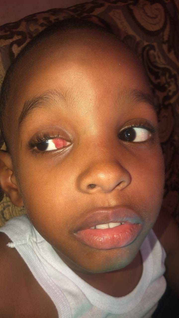 Boy loses eye to cancer