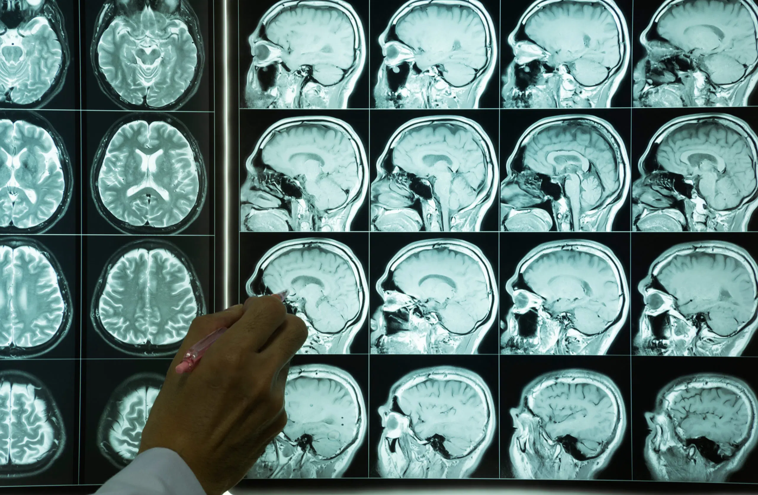 Guyana among hardest-hit in the Americas for brain disorders