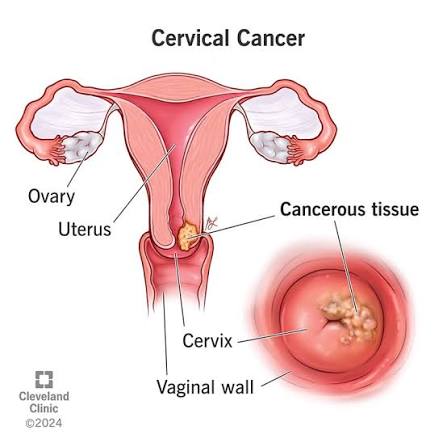 Cervical Cancer: the silent invader we can outsmart